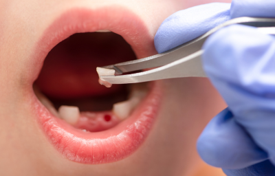 Tooth Removal or Extraction