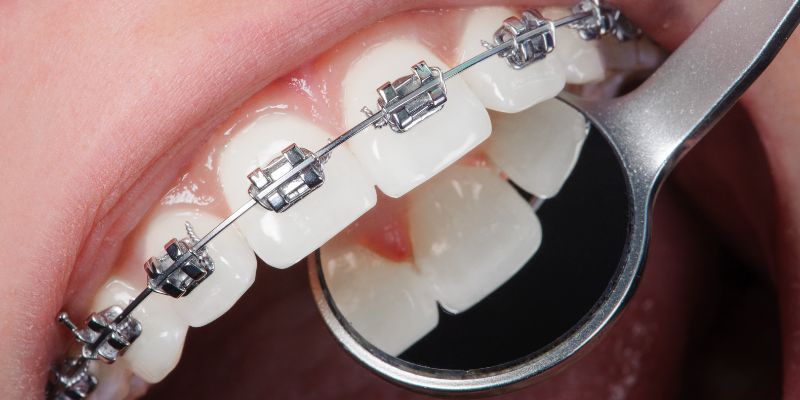 Dental Braces