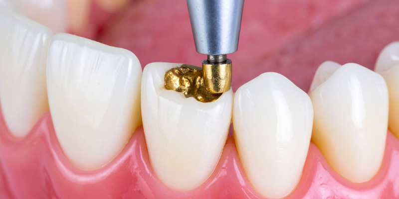 Tooth Coloured Filling